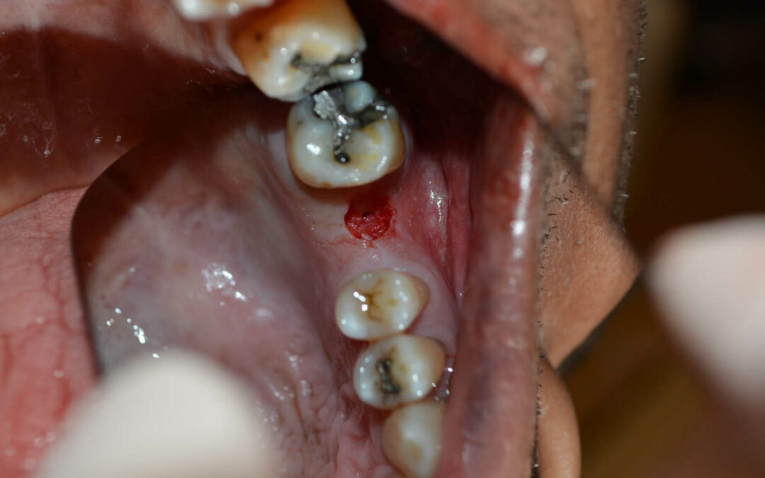 INTRODUCING THE MINIMALLY INVASIVE DUAL FIXATION DENTAL IMPLANT